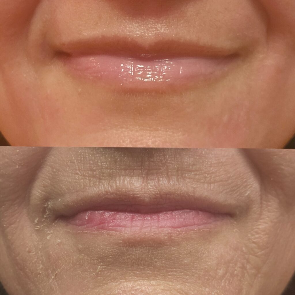 Lips comparison top healthy skin and bottom peeled skin