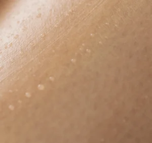 Hydrated skin with hyperpigmentation, exfoliated and oil on the skin